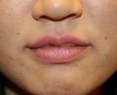 Feel Beautiful - Fuller Lips by Juvederm Ultra Plus - Before Photo